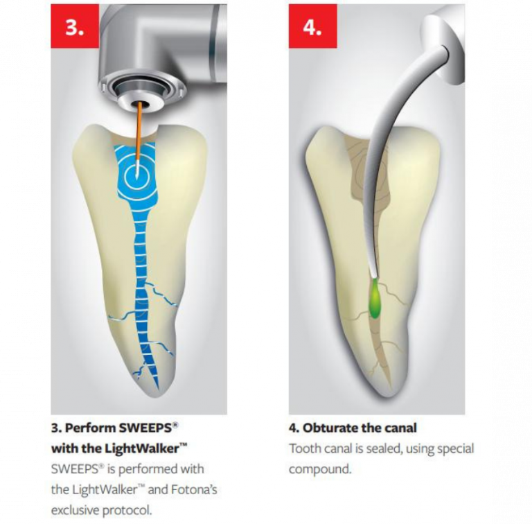 Diagram of Fotona PIPS and SWEEPS photoacoustic laser root canal disinfection