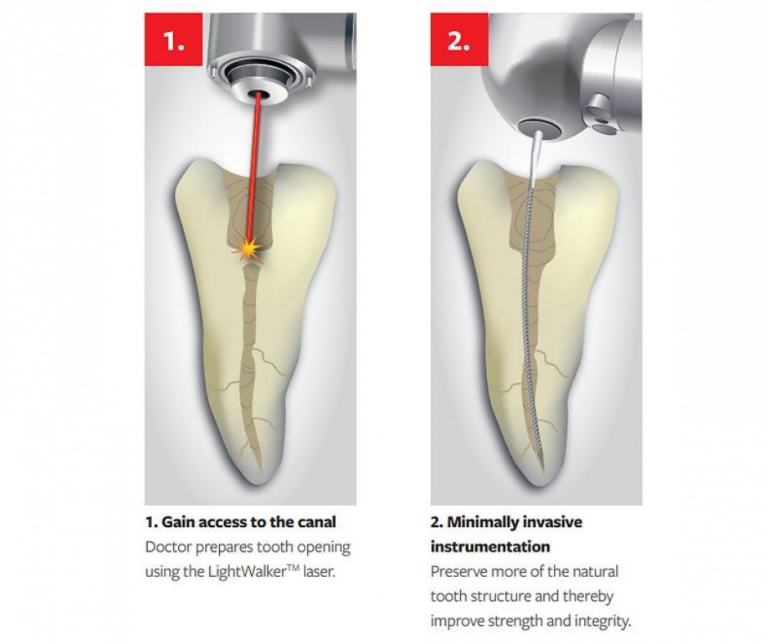 Diagram of Fotona TwinLight dual-wavelength laser therapy for periodontal disease treatment